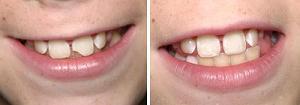 Comparison of boy with chipped tooth and fixed tooth